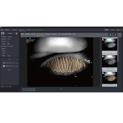 Évaluation de la fonction des glandes de Meibomius