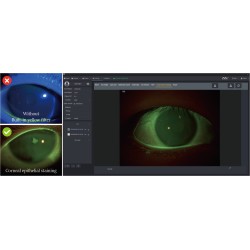 Coloration de la cornée à la fluorescéine de sodium