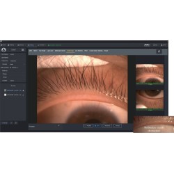 'examen de la forme globale du bord de la paupière et de son léger changement