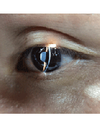 lampe à fente - biomicroscope